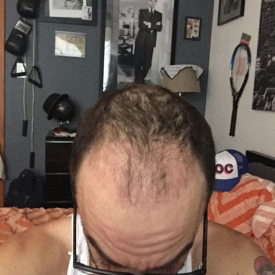 Bald Balding Man Hair Transplant Before and After Body Positivity Mens Blog IMG_0939