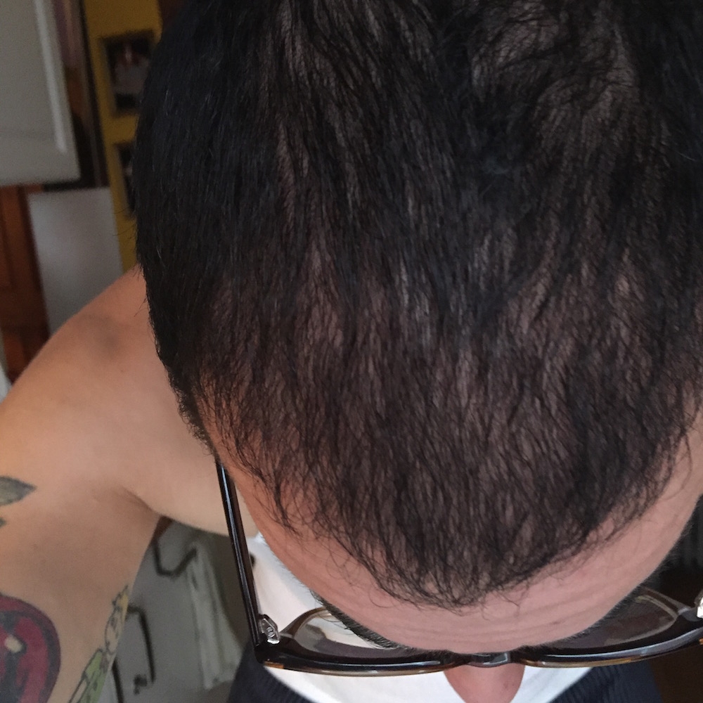 Bald Balding Man Hair Transplant Before and After Body Positivity Mens Blog IMG_3259