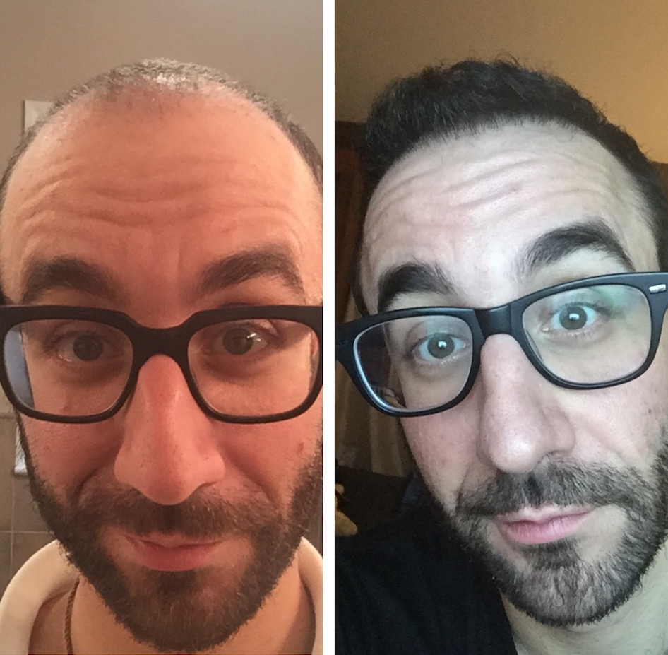 Bald Balding Man Hair Transplant Before and After Body Positivity Mens Blog IMG_4574